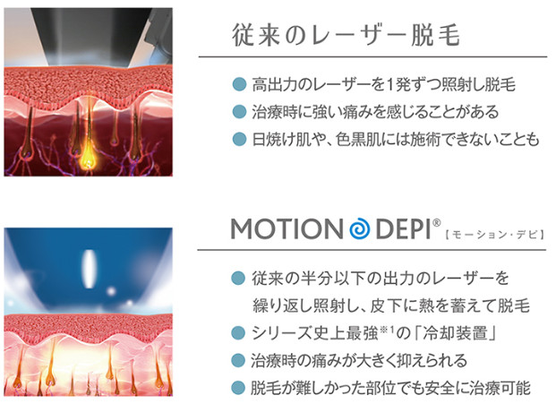 ソプラノアイスと従来の脱毛の比較